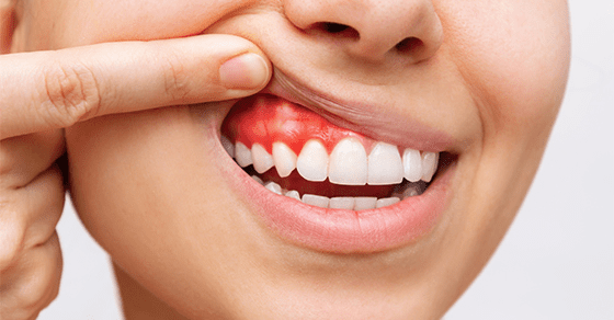 Bleeding Gums? Here's What Your Mouth is Trying to Tell You 1 What Is Periodontitis, and How Can I Avoid It?